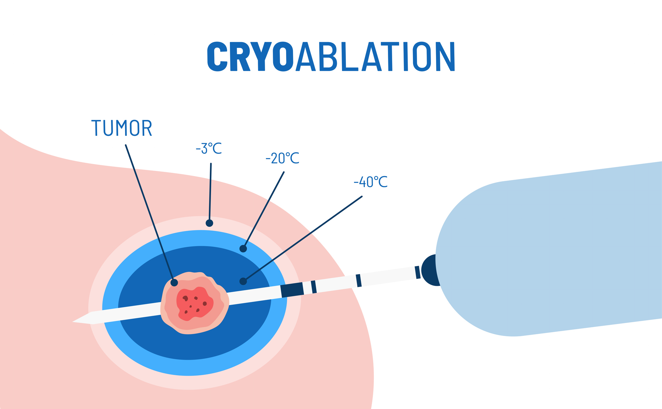 Cryoablation procedure vector illustration. Targeted medical procedure for breast cancer. Minimally invasive tumor treatment. Liquid nitrogen and cryogenic tissue ablation.