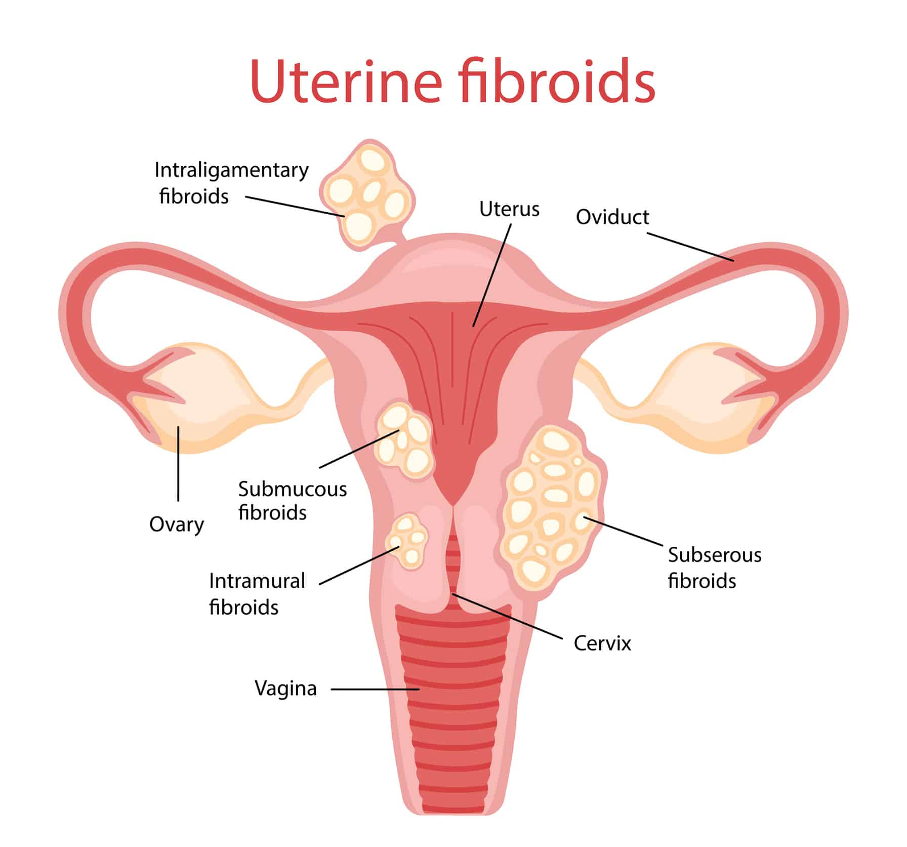 Uterine Fibroid Embolization (UFE) in Sarasota, FL 1 Fibroids. Diseases of the female reproductive system. Vector illustration in flat cartoon style