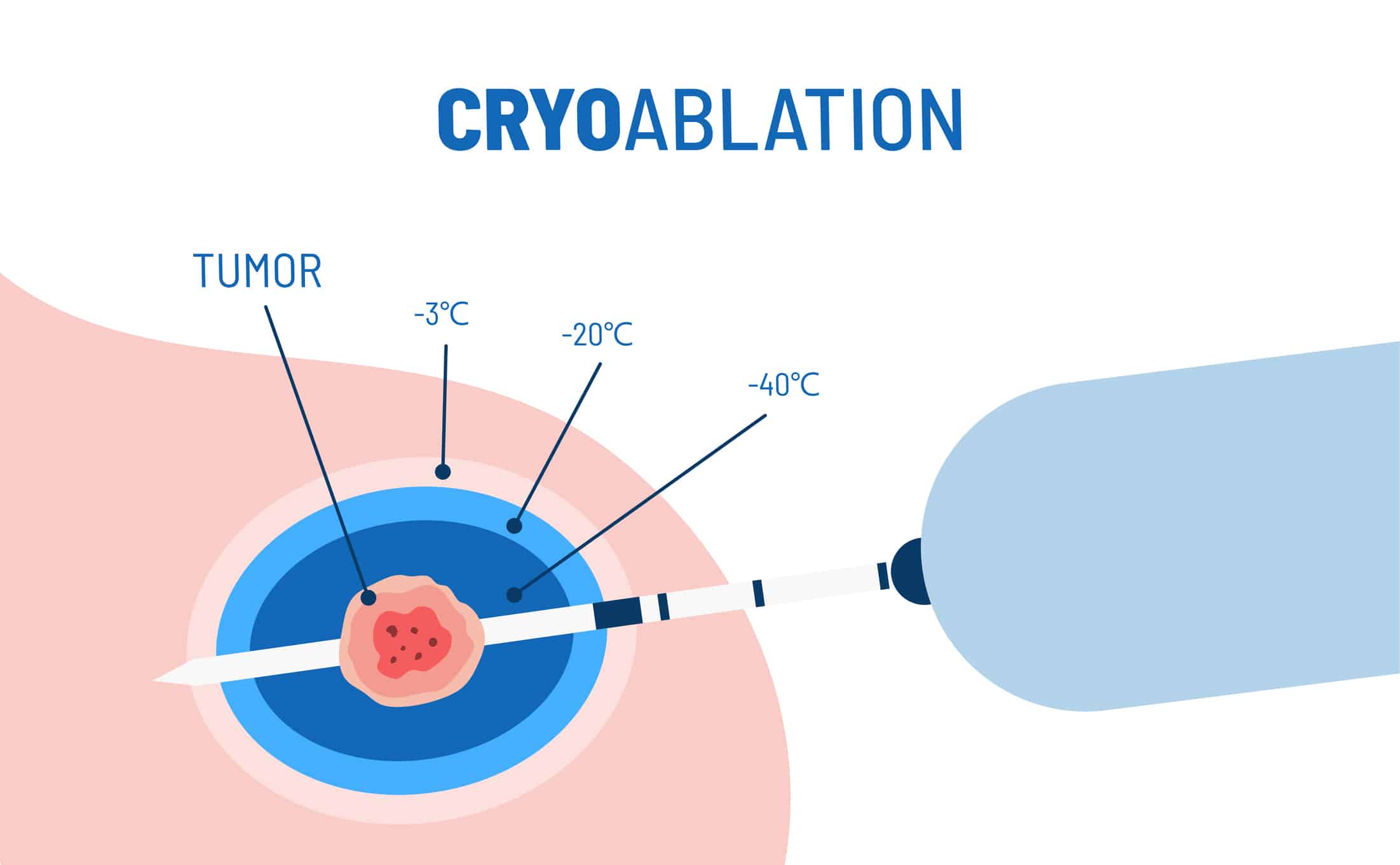 Interventional Oncology in Sarasota, FL 1 Cryoablation procedure vector illustration. Targeted medical procedure for breast cancer. Minimally invasive tumor treatment. Liquid nitrogen and cryogenic tissue ablation.